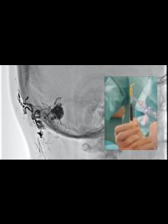 [x]脳硬膜動静脈瘻のONYXの使用法 - YouTube